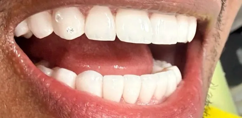 Después: diseño de sonrisa