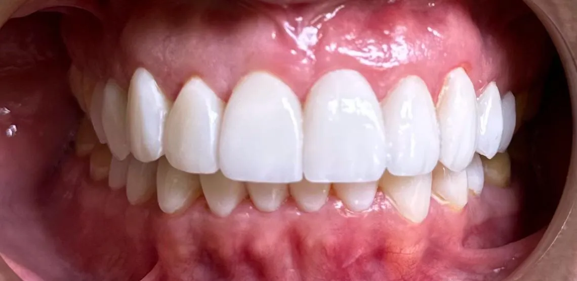 Después: diseño de sonrisa