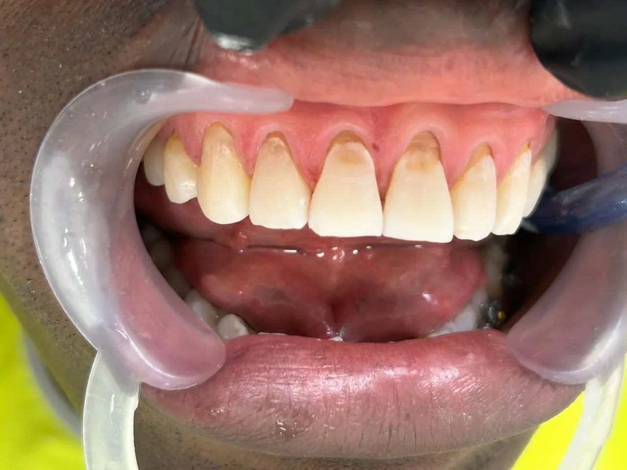Antes: recesión gingival y desgaste en los dientes superiores