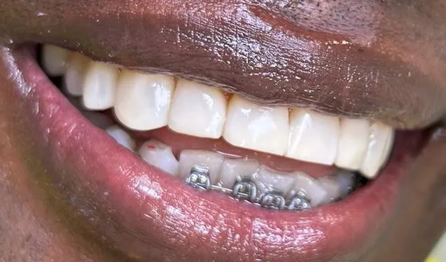 Después: carillas superiores de alta estética con ortodoncia inferior